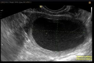 Жидкость за маткой на узи после кесарева сечения