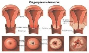 Рак шейки матки приговор или нет