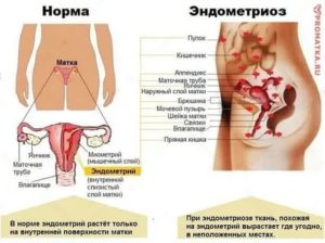 Эндометриоз боль при ней может отдавать в ногу