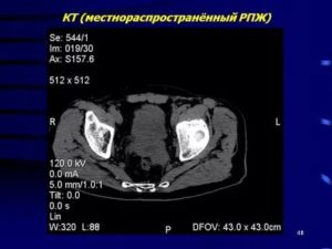 Что такое местнораспространенный рак предстательной железы