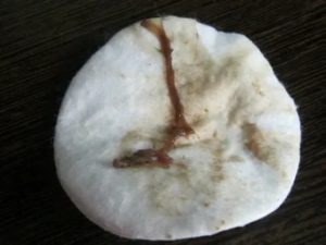 Могут ли быть коричневые выделения при молочнице во время беременности