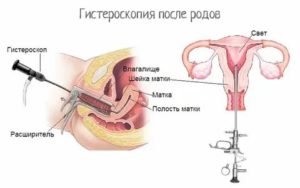 Гистероскопия матки при кровотечении