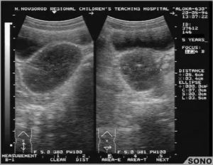 Образование повышенной эхогенности в яичнике что это такое на узи