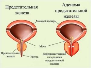 Аденома предстательной железы можно ли греть