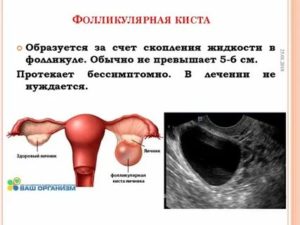 Сколько может не рассасываться фолликулярная киста яичника