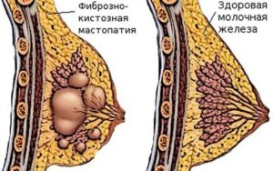 Можно ли делать массаж груди при фиброзно-кистозной мастопатии