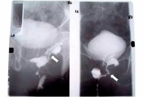 Свищ на мочевом пузыре при раке шейки матки