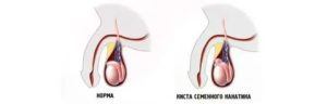 Опухоль семенного канатика у мужчин симптомы лечение