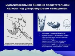 Что такое мультифокальная биопсия предстательной железы