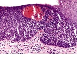 Плоскоклеточный рак in situ шейки матки что это