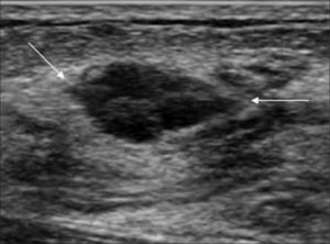 Липосаркома молочной железы на узи