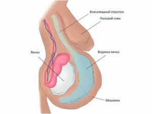 Может ли водянка яичка влиять на потенцию