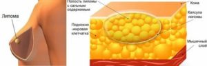 Сода от липомы молочных желез