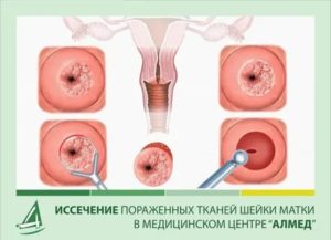 Какие препараты принимать после конизации шейки матки