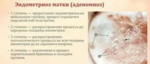 Эндометриоз 3 степени лечение отзывы