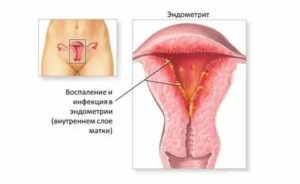 Покалывание в области матки при молочнице