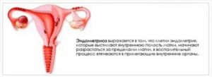 Спринцевание креолином при эндометриозе