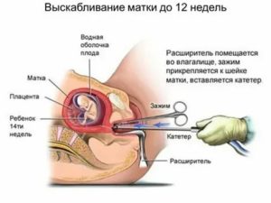 Когда лучше делать чистку матки до месячных или после