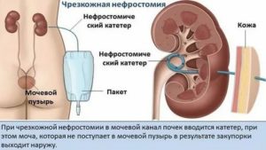 Нефростома в почке при раке шейки матки