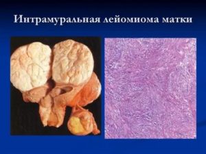 Препарат лейомиома матки что это такое