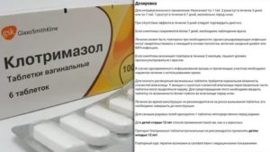 Лечение молочницы перед родами клотримазолом