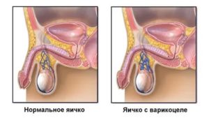 Почему после долгой эрекции болят яички