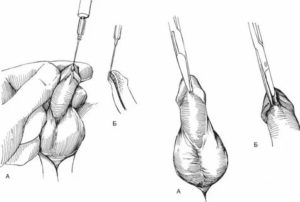 Опухоль на уздечки полового члена