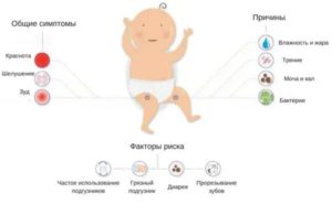 Молочница у детей в паховой области симптомы лечение у мальчиков
