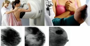 Мастопатия молочных желез делать узи или маммография