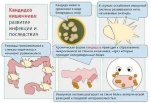 Неинвазивная форма кандидоза кишечника это