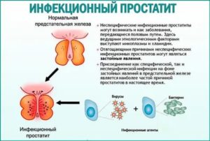 Если у партнера инфекционный простатит