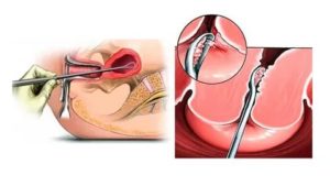 Что такое диагностика выскабливание полости матки