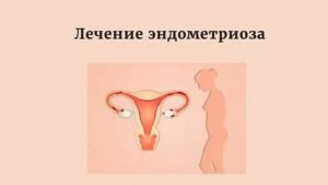 Миома матки и эндометриоз лечение пиявками