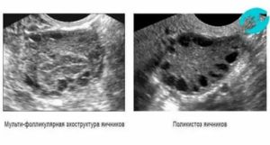 Мультифолликулярная структура яичников узи