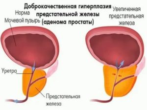 Гирудотерапия при лечении аденомы предстательной железы