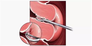 Выделения после выскабливания эндометрия при климаксе