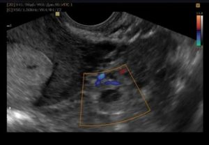 Могут ли на узи по яичникам определить беременность