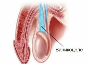 Воспаление семенного канатикам диагностика