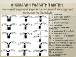 Пороки развития матки методы диагностики