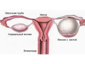 Может ли перед месячными болеть придатки