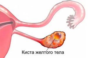 Как влияет утрожестан на кисту желтого тела