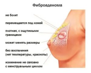Фиброаденома молочной железы при климаксе