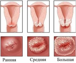 Может ли причиной молочницы быть эрозия шейки матки у