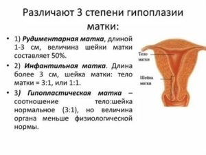 Размеры инфантильной матки при узи