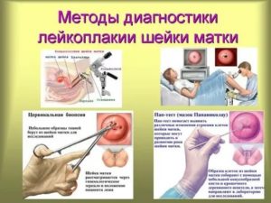 Цитологическое исследование шейки матки при лейкоплакии