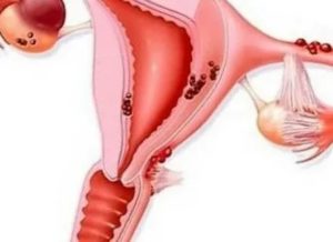 Миома матки в сочетании с эндометриозом при климаксе