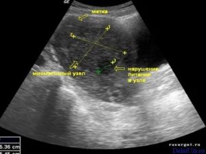 Может ли быть ошибка на узи при миоме матки