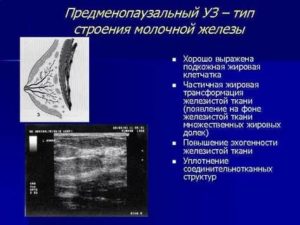 Морфотипы по узи молочной железы