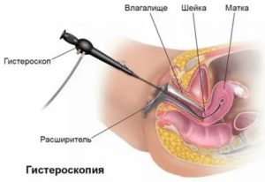 Гистероскопия матки в альтравита