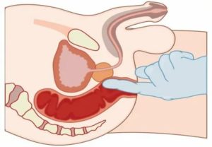 Что такое ректальный массаж при простатите
